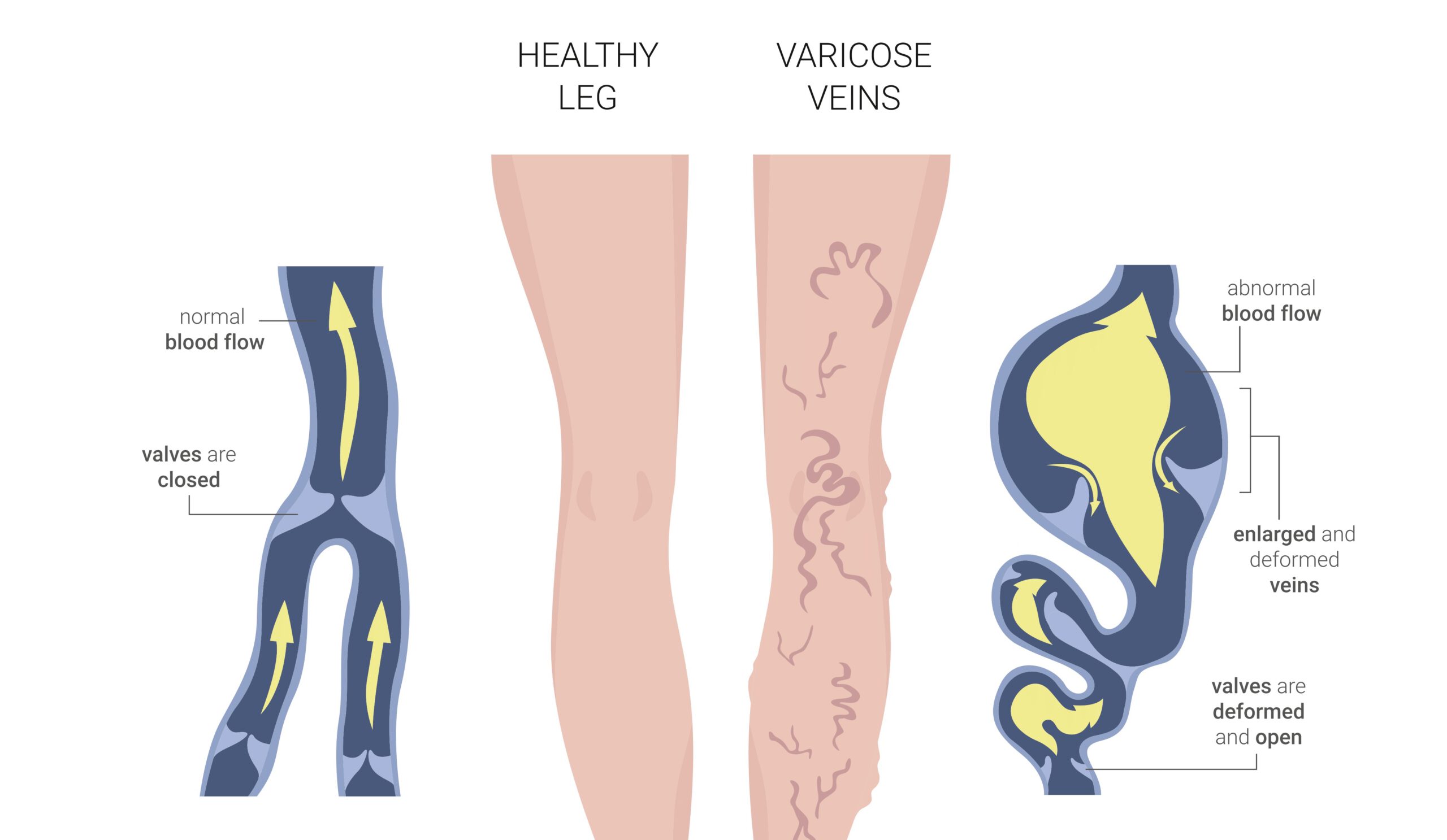 Infographic: Vascular Disease – Varicose Veins - SOT Medical Systems