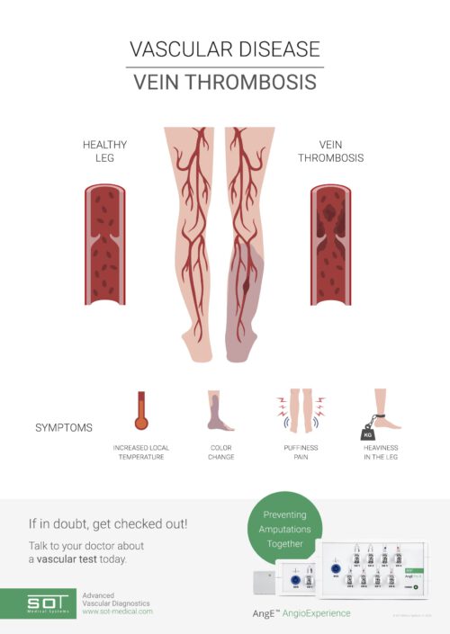 Possible Dvt Infographic: Vascular Disease - Vein Thrombosis - SOT Medical Systems