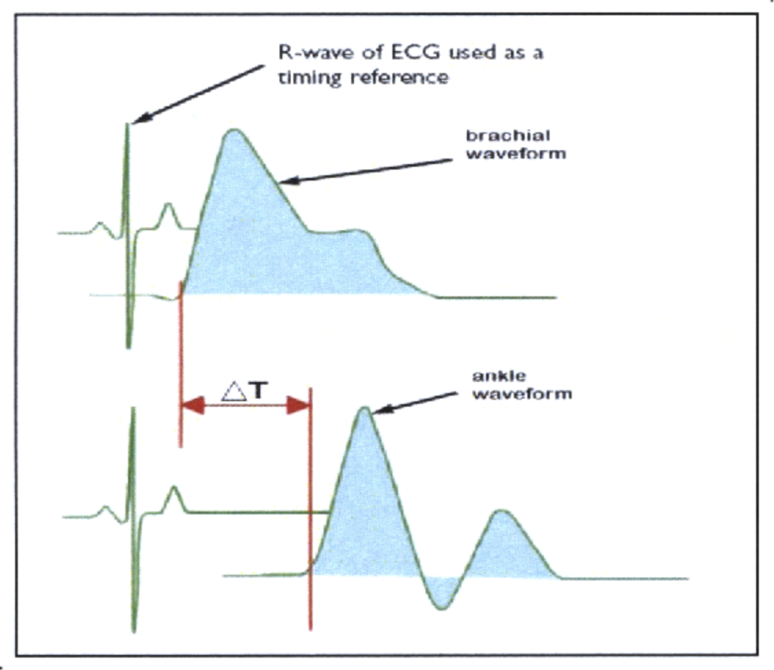 Pulse Wave Velocity: A Key Indicator of Arterial Stiffness - SOT ...