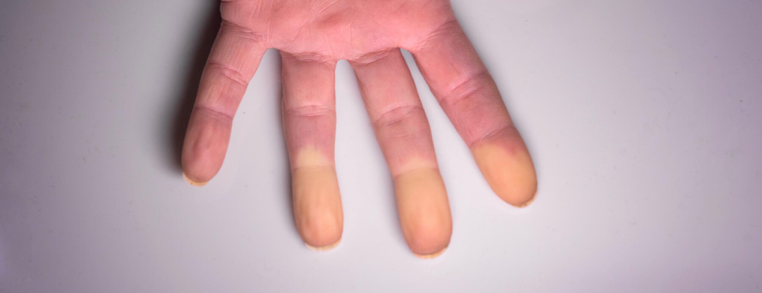 Raynaud’s Syndrome: Understanding the Causes, Symptoms and Importance of Early Assessment