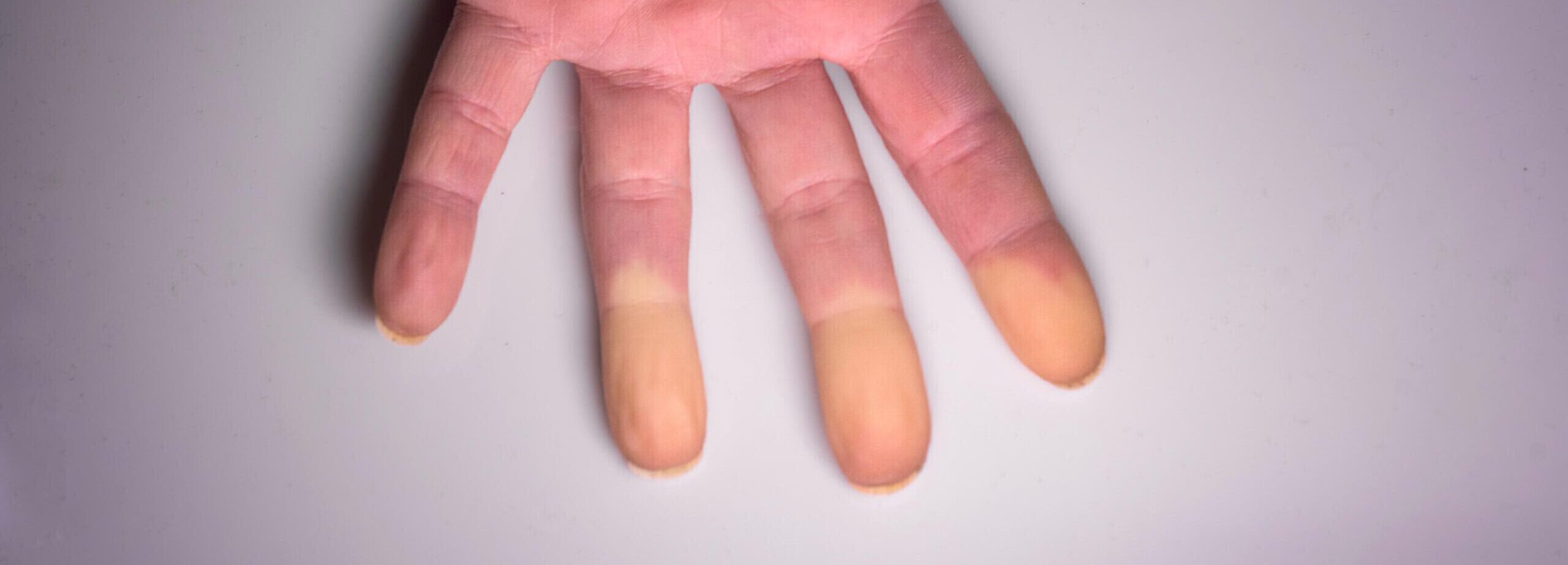 Raynaud-Syndrom: Ursachen, Symptome und warum eine frühzeitige Abklärung wichtig ist